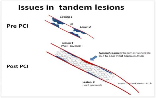 Tandem coronary lesion