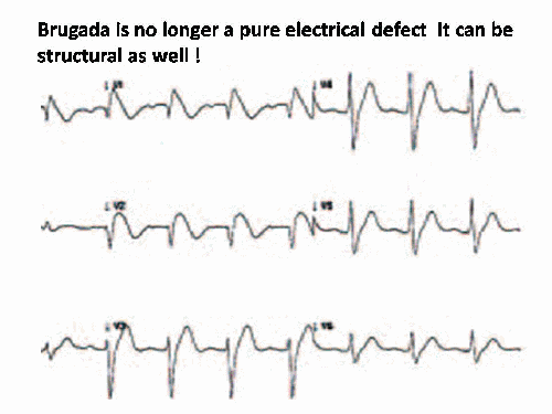 brugada syndrome | Dr.S.Venkatesan MD