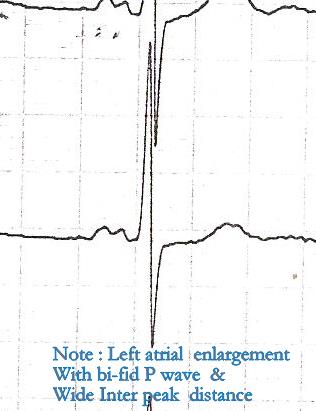 ecg lvh bifid p waves