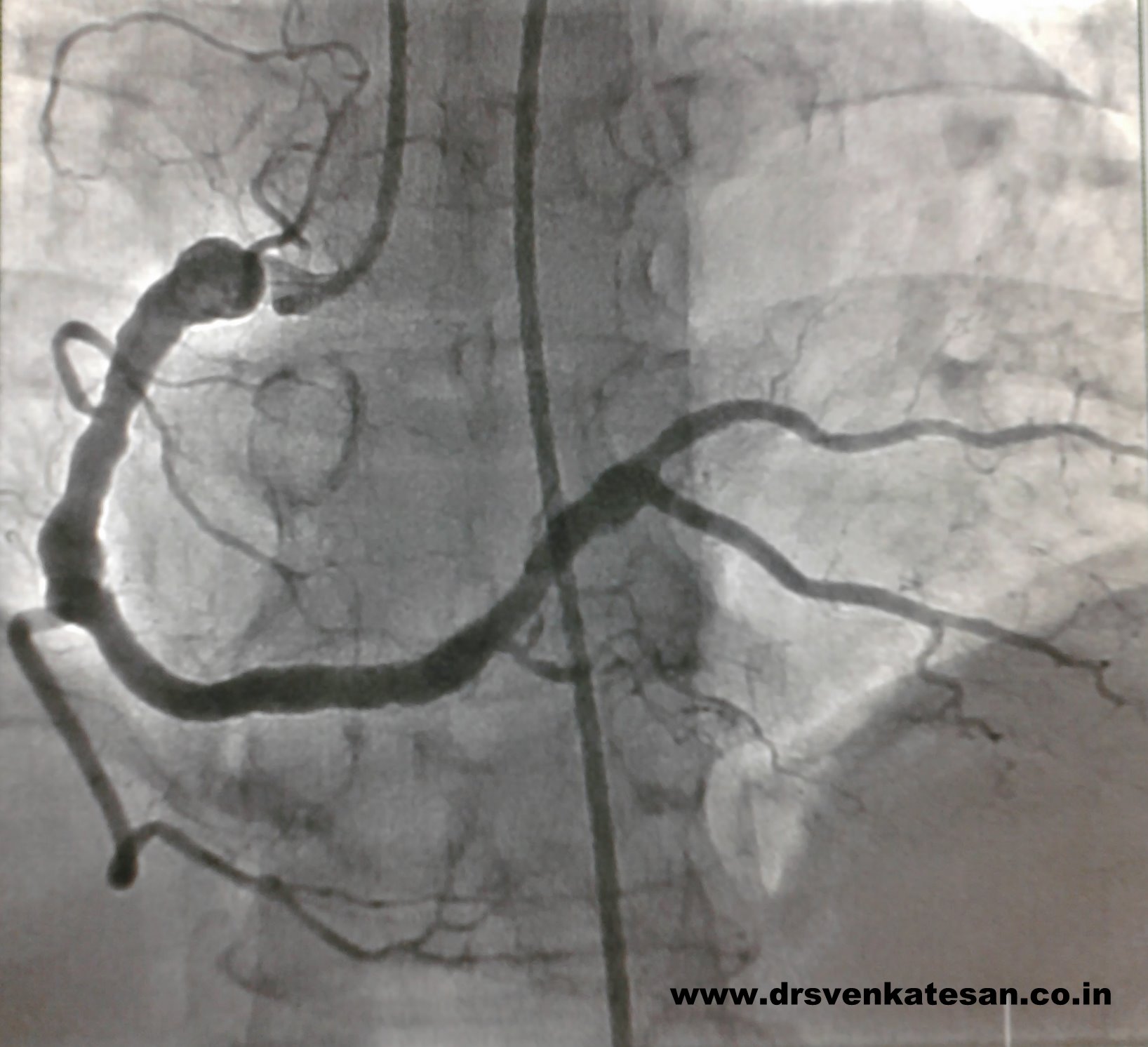 coronary ectasia aneurysm 2 dr s venkatesan