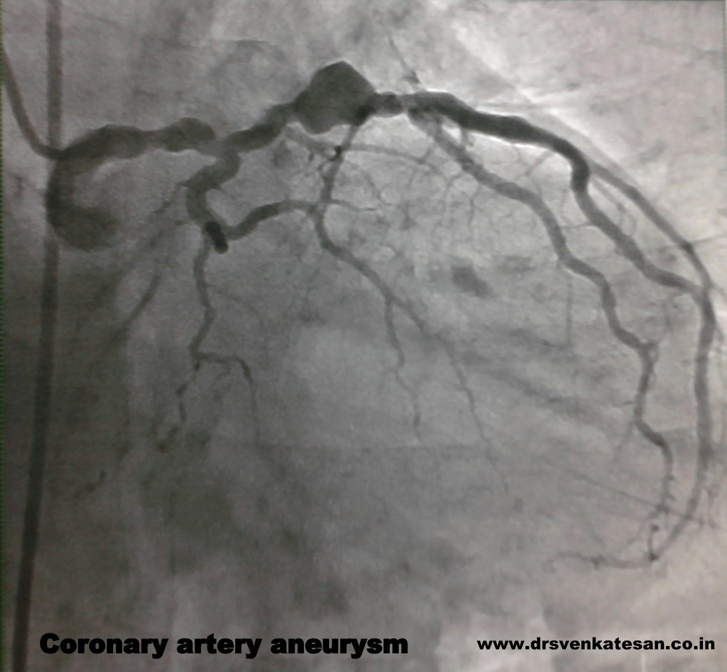 coronary ectasia aneurysm 3 dr s venkatesan