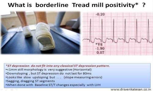 tmt est borderline positive equivocal mildly positive