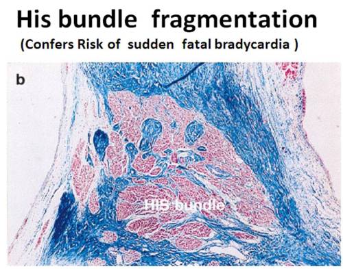 non compacted av node his bundle fragmentation septation non compacted left ventricle