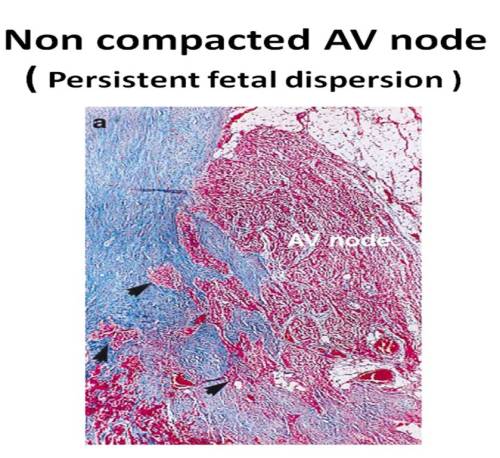 persistent fetal dispersion of av node non compaction of av node