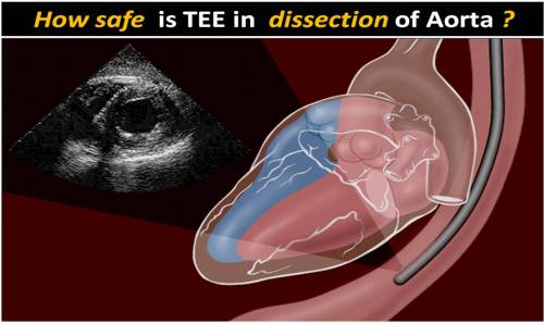 What is the risk of aortic rupture during TEE in “dissecting” aneurysm ...