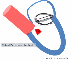 mitral para valvular leak | Dr.S.Venkatesan MD
