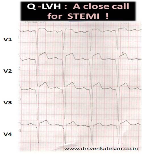 Q-LVH INCOMPLET LBBB STEMI DIFFERENTIAL DIAGNOSIS
