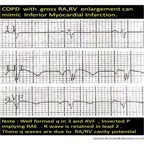 copd ra rv enlargement mimic inferior mi q waves in 2 3 avf differential diagnosis