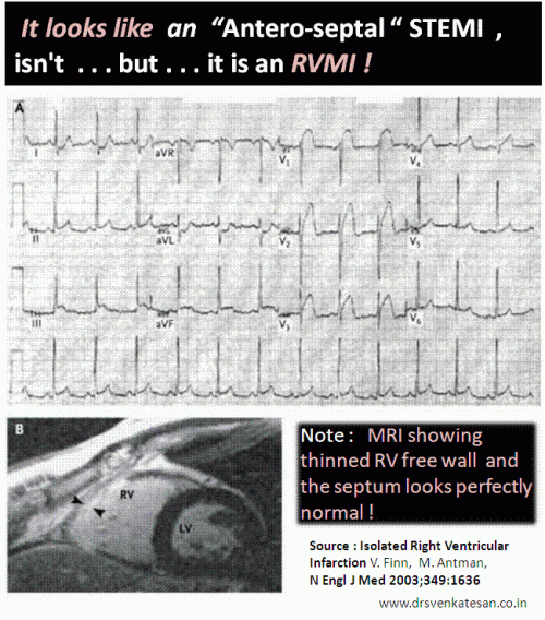 isolated rvmi right ventricular infarction due lad disease st eelvation in v1 v2 v3