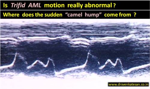 mitral valve motion in m mode echocardiography trifid