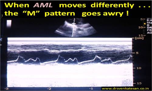 mitral valve motion trifid m pattern in m mode echocardiography