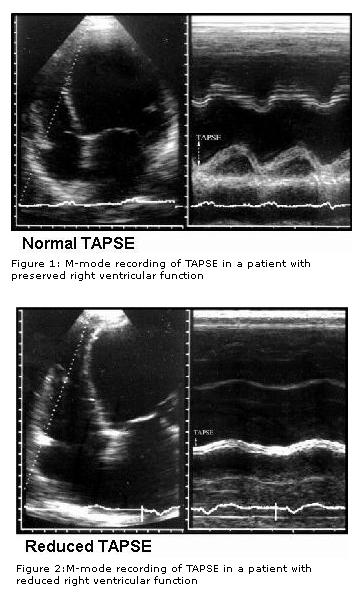 Normal and depressed tapse coronary artery swing av groove motion