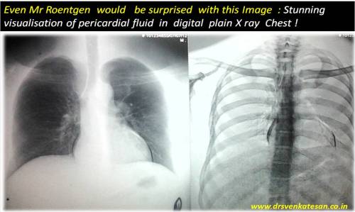 pericardial fluid in plain xray chest xray chest roentgen