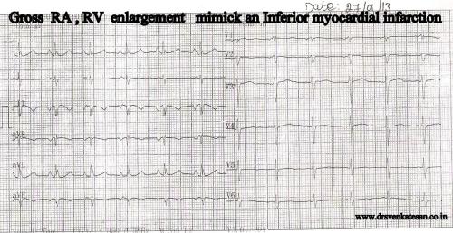 rv cavity potential in inferior leads mimicking inferior mi q in