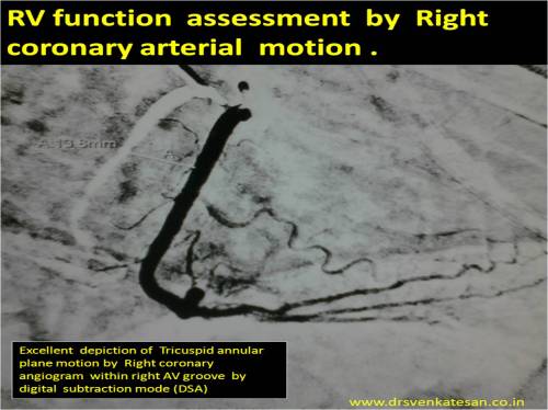 tapsee rca motion by coroanry angiogram rv systolic function tricuspid annulus motion right av groove atrio ventricular grrove mapsee m mode echo