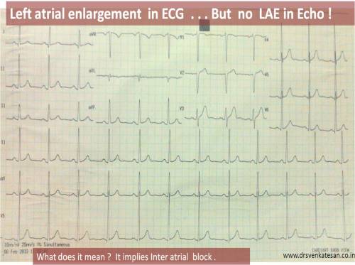 left atrial  enlargement by ecg limitations sensitivity