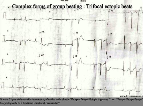 trigeminy group beating vpds sinus node dysfunction escape capture