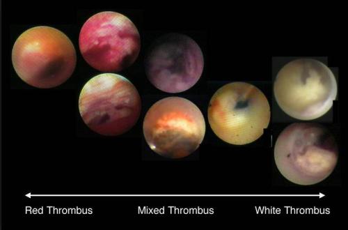coronary angioscopy  Yasunori Ueda www.invasivecardiology