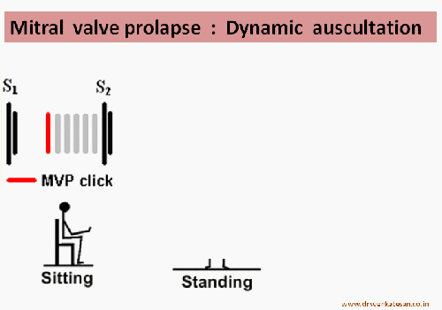 squatting dynamic auscultation mvps mitral valve prolapse