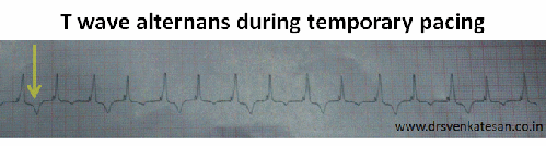 t wave alternans