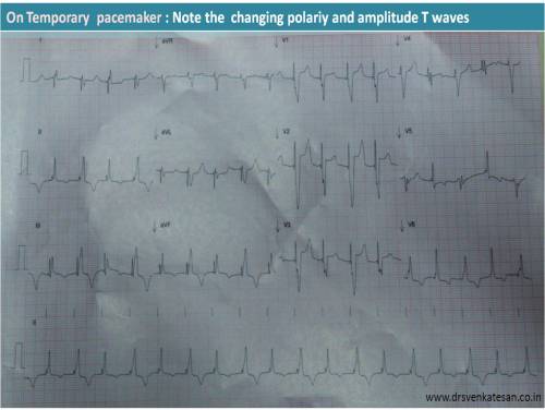 T waves alternans torades de pointes 3