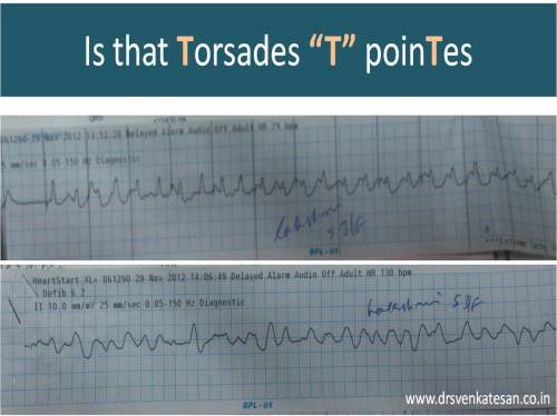T waves alternans torades de pointes