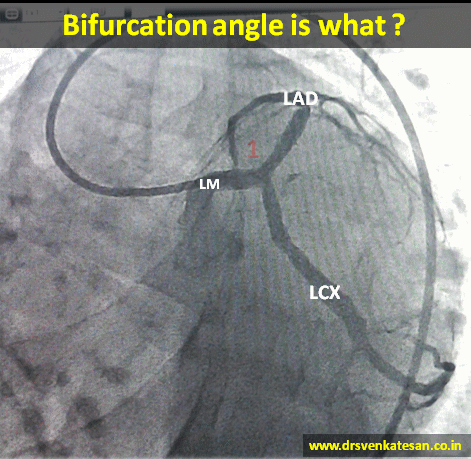 bifurcation angle