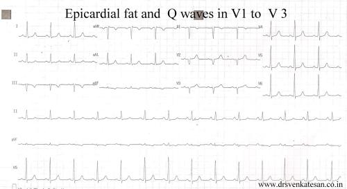 epicardial fat and poor r wave in v 1 v 2 v3 q  waves