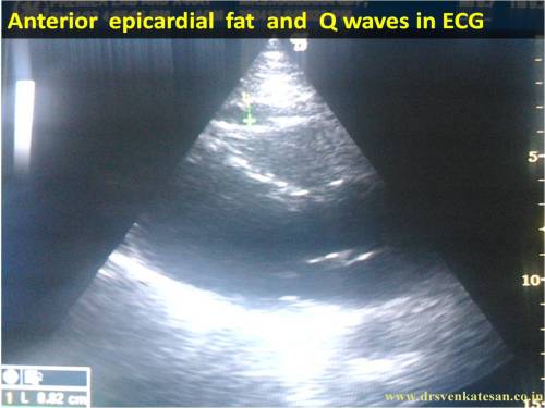 epicardial fat and q waves in ecg pesudo infarct non infarct 2  q