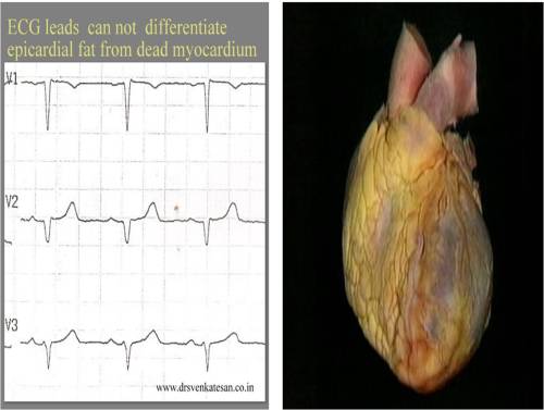 epicardial fat and q waves in ecg pesudo infarct non infarct fat 2  q