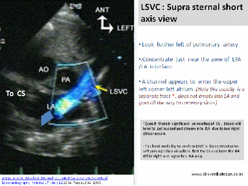 lsvc persisitence lsvc left superior vena cava