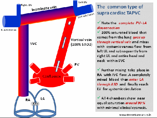 tapvc total anomalous pulmonary venous conncetion vertical vein