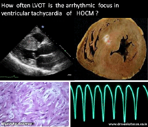VENTRICULAR TACHYCARDIA 002