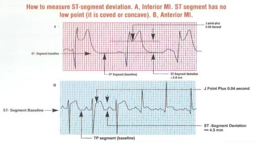 how to measure ST  elevation in STEMI 2