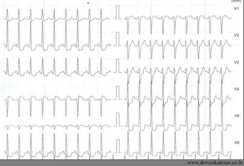 positive est and unstable angina