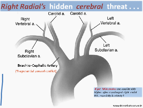 right radial artery coronary angiogram  pci  risk of stroke 002