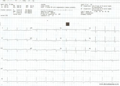 sinus premature beat spb 2