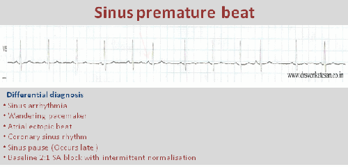 sinus premature systole spd sinus node ectopics002
