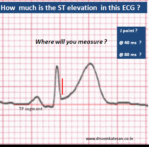 where will you measure st segment