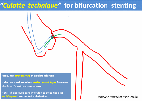 culotte technique  stenting ptca pci 004