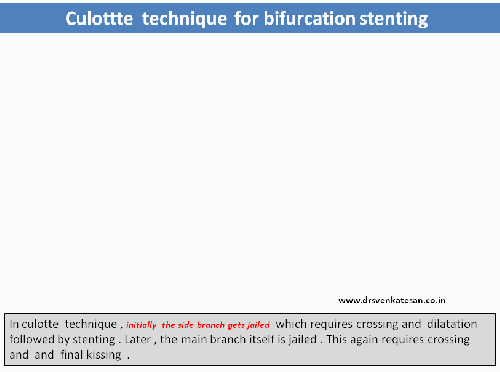 culotte technique  stenting ptca pci