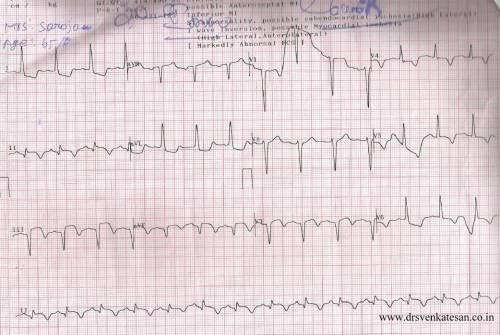 inferior MI evolved 2