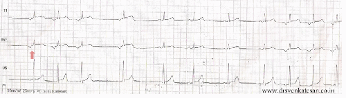 Twisting Pacemaker P wave twisting : An extreme form of wandering pacemaker . | Dr.S ...