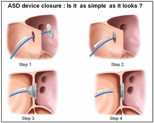 asd-closure-device-www-drsvenkatesan-com