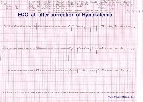 hypokalemia STEMI ECG changes 001