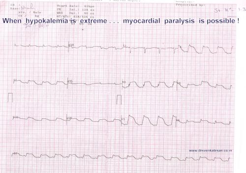 hypokalemia STEMI ECG changes