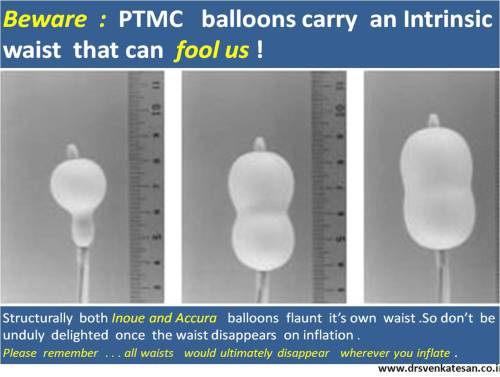 PTMC balloon accura Inoue waist mitral stenosis percutaneous mitral commissurotomy