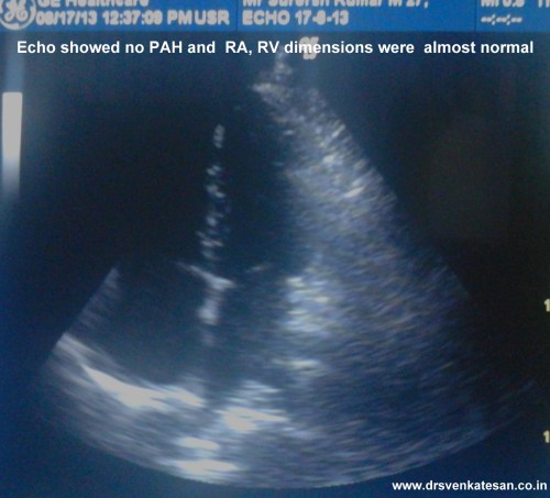 pulmonary embolism  3  total occlusion of LPA
