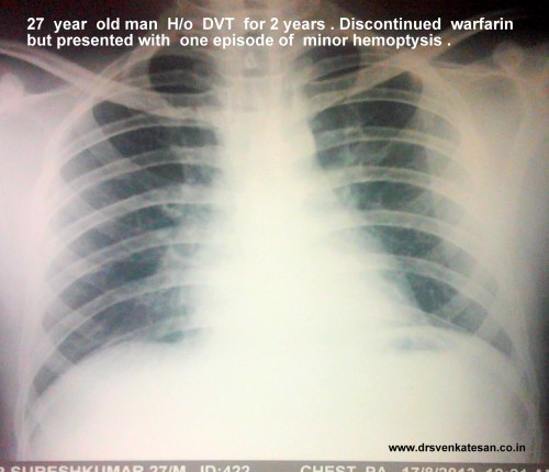 pulmonary embolism  3  total occlusion of LPA
