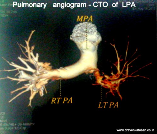 pulmonary embolism total occlusion of LPA